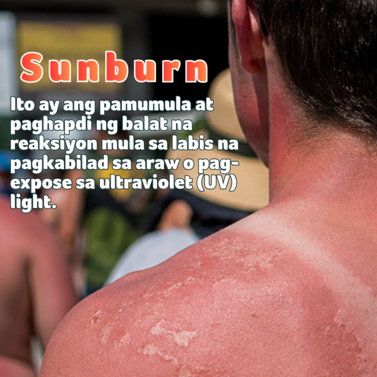 #SUNBURN: Huwag maliitin, seryosong pinsala rin sa balat!